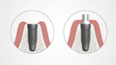 2345-thumb-Implant-supported-vs-abutment-supported.png