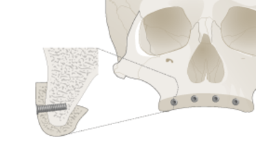 3067-grafting-upper-jaw.png