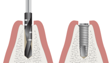 3210-Parallel-implant-placement.png