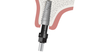 3220-tapered-implant-placement.png