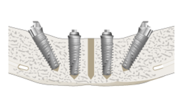 3430-placement-of-implant-angulation.png
