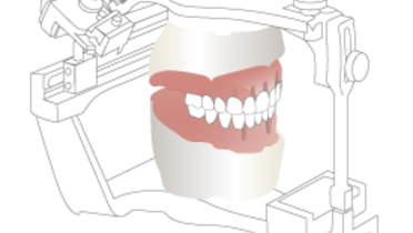 3630-Implant-overdenture-trial-placement.png