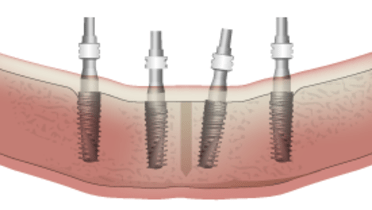 3816-parallel-vs-non-parallel-implants-.png
