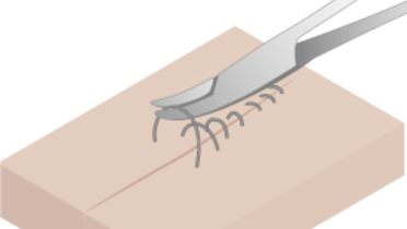 4130-suture-removal.png