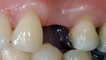 Consensus on single tooth_cover image.jpg