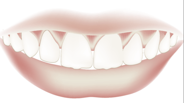 TG2_2130_thumb_Condition of Natural Teeth.png