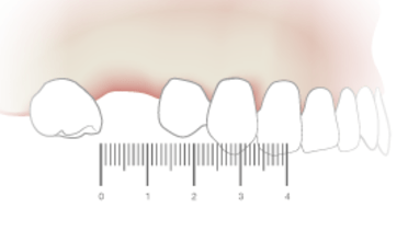 TG2_2170_thumb_Bone-Volume-and-Interdental-Space.png