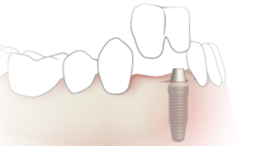 TG2_3430_thumb_Single-implant-crowns-with-cantilever.png