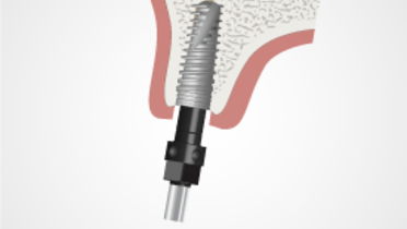 TG2_4152_Thumb-tapered-implant-placement.png