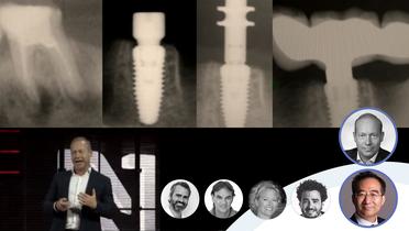 Immediate Implants Episode 5: Challenges in the Maxilla and Mandible