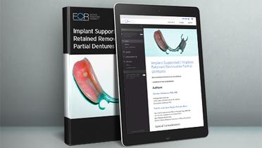 ePaper: Implant Supported / Implant Retained Removable Partial Dentures (IRPDs)
