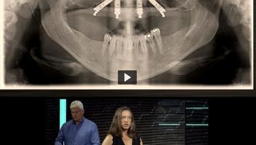 A patient with an edentulous maxilla and medium bone density – Immediate Function Episode 1