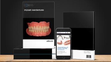 eBook: Implant overdentures: From Diagnosis to Maintenance
