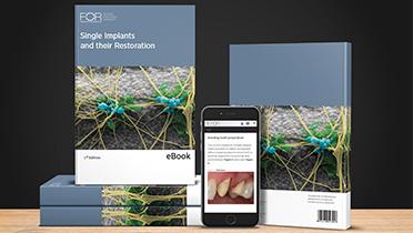 eBook: Single Implants and their Restoration