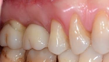 Restoring the molar region with wide platform implants