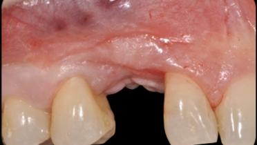 Initial clinical situation. The pre-operative buccal view is showing a missing canine associated with mucogingival deformities as the results of a traumatic extraction of the retained canine. A bone graft was attempted as well as an implant insertion: both bone graft and implant failed.